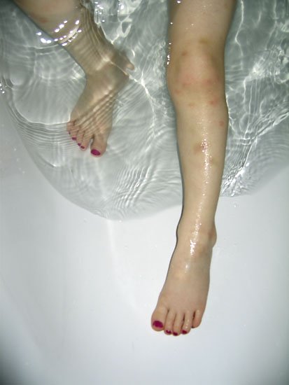 pedicure and bruises