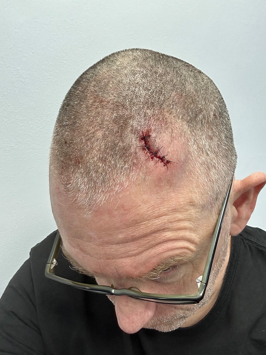 5 stitches, bitches