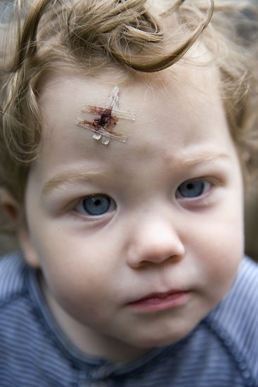 z and his (bumped) head